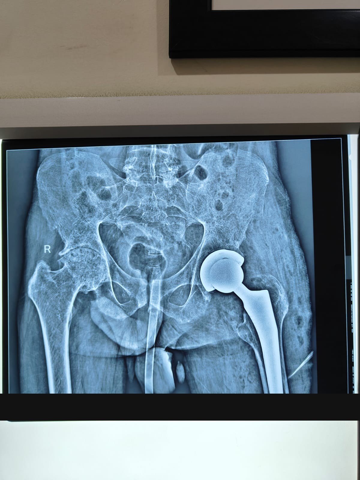 Pelvis X-ray after total hip replacement