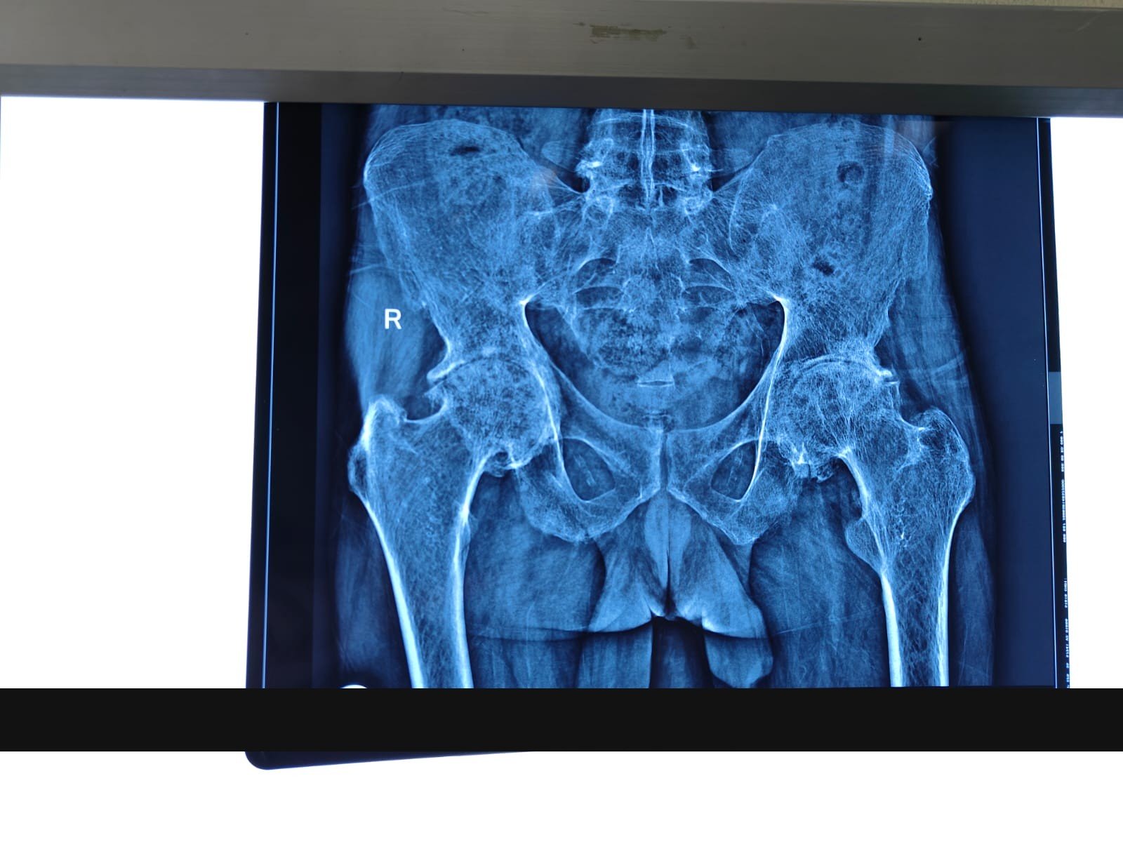 Pelvis with both hips X-ray