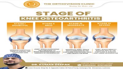 Stages of Knee Osteoarthritis Explained