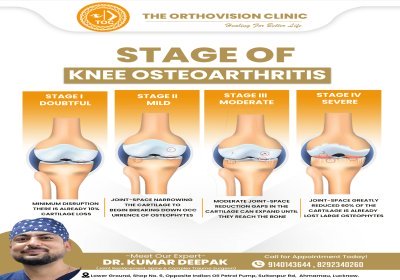 Stages of Knee Osteoarthritis Explained