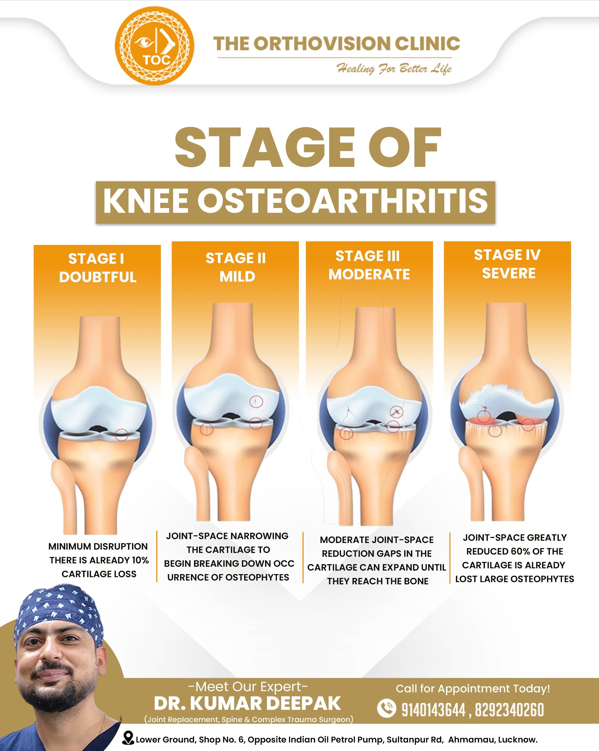 Stages of knee osteoarthritis